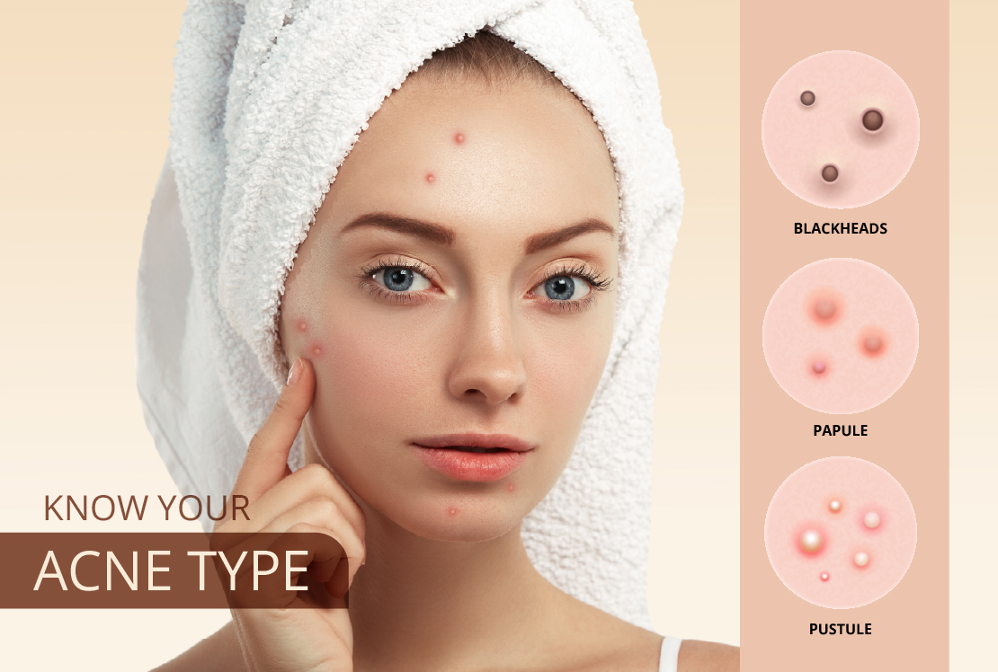 Know Everything About Acne Types Of Acne And Treatment Methods